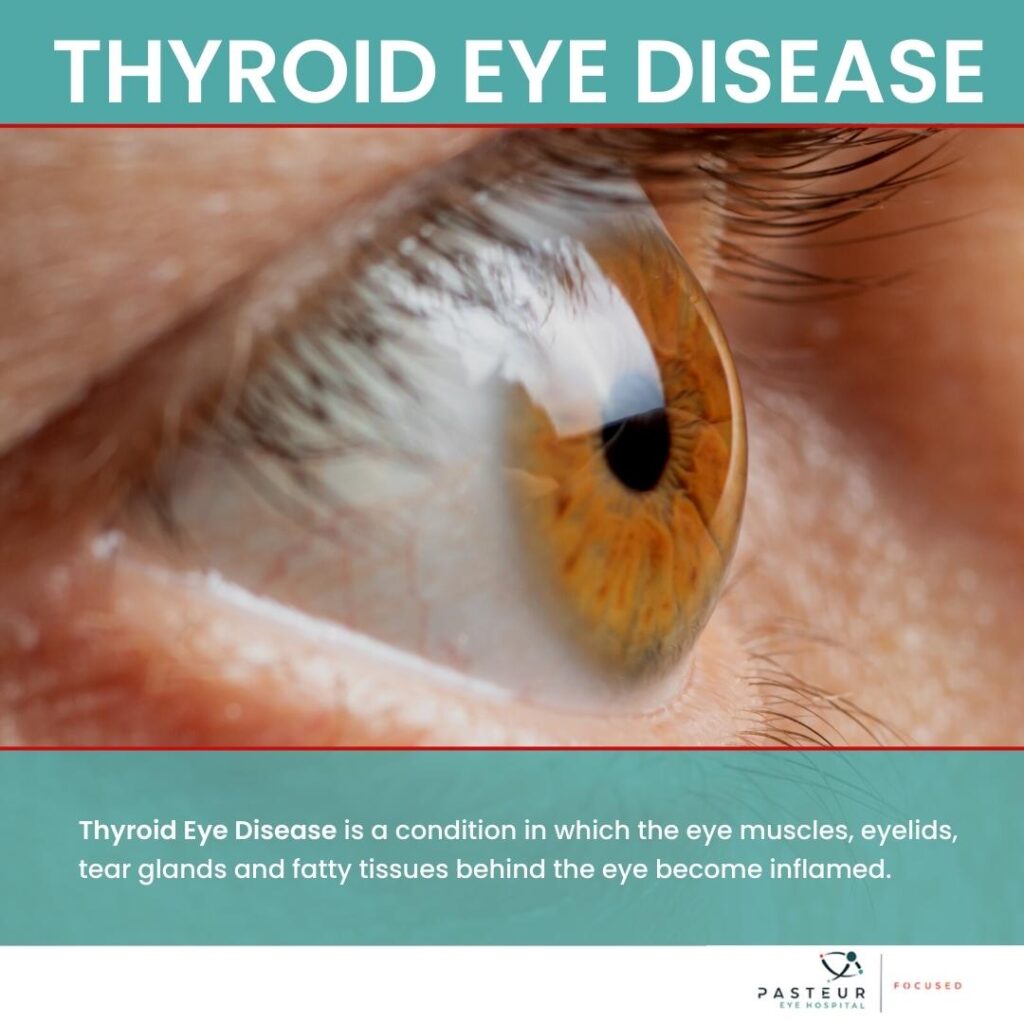 Thyroid eye disease is a condition in which the eye muscles, eyelids, tear glands and fatty tissues behind the eye become inflamed.