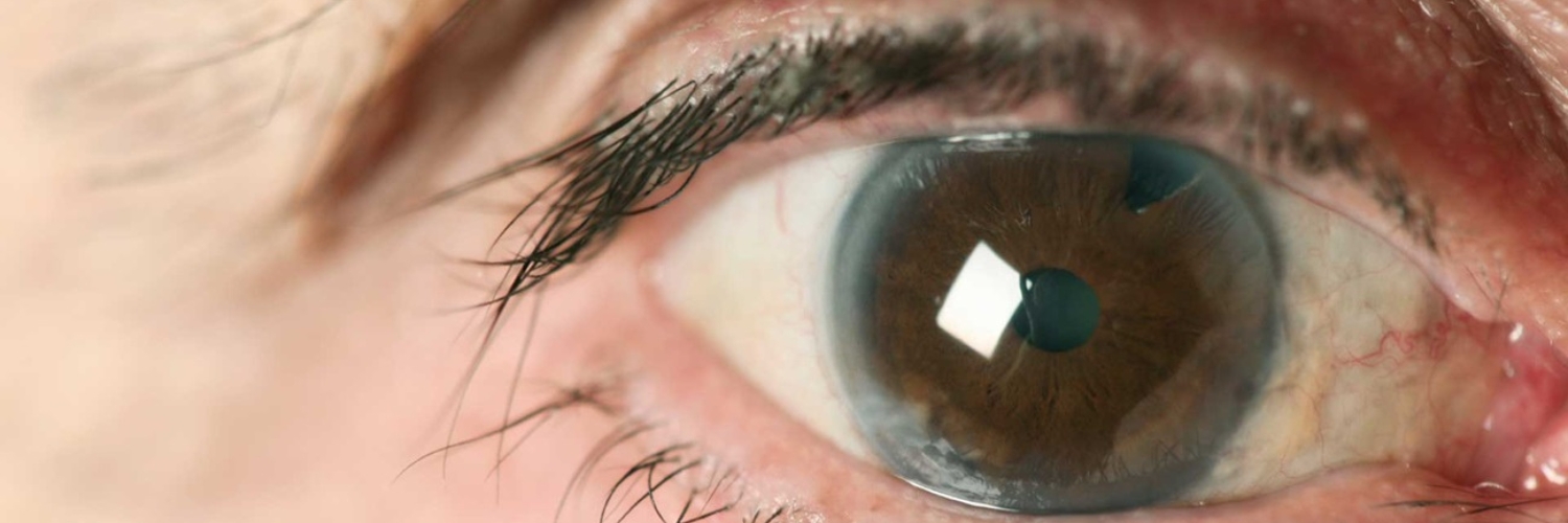 Cataracts are a condition where the lens inside your eye becomes progressively opaque, resulting in blurry vision.