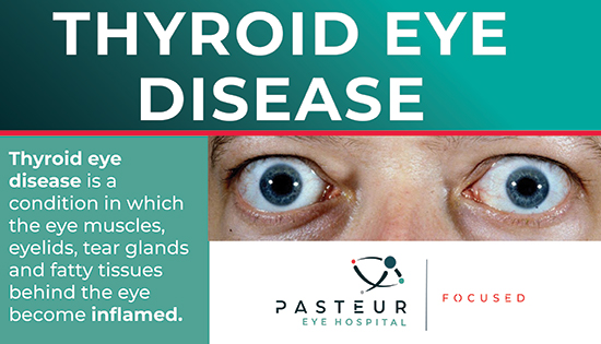 Thyroid Eye Disease - Pasteur Eye Hospital | Eye Care Centre in ...